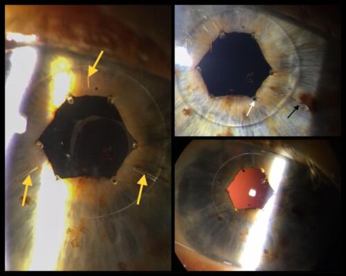 Artificial intraocular lens fixed in the pupil